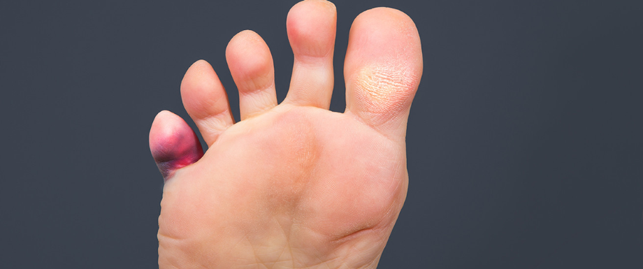 Diabetes and feet – Hammertoe symptoms